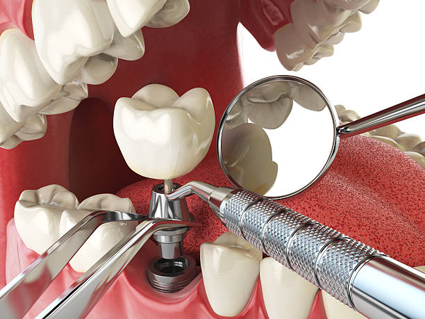 Best Broken or Chipped Tooth Repair in Lake Ketchum, WA